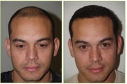 Hair transplant
