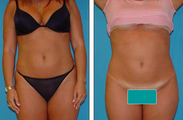 Liposuction Before & After