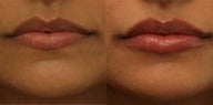 Lip Augmentation