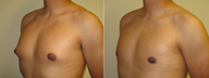 Male Breast Reduction