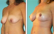 Breast Lift- Mastopexy
