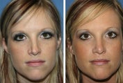 Rhinoplasty