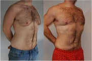 Male Before and After Lipo Chest and Abdomen