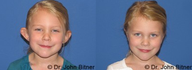 Otoplasty