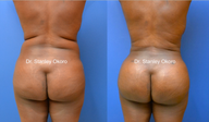 35 year old fat transfer to buttocks