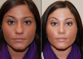 Rhinoplasty and Lip Augmentation with Silikon-1000