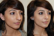 Rhinoplasty Surgery. 1 month post-op.