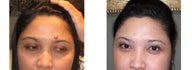 Mole Removal photos