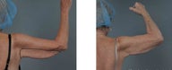 ThermiSculpt patient