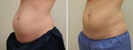 38 Year Old Mother of 2 - CoolSculpting Fat Reduction to Abdomen