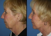 Facelift with implants and Perioral Resurfacing