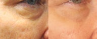 ePrime and CO2RE treatment on 64 year old Female