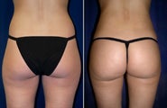 Liposuction
