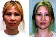 Asian Rhinoplasty with Nasal Implants