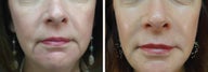 61 Year Old Female with facial fillers, skin care, and Botox
