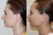 Otoplasty Surgery