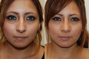 Rhinoplasty Surgery. 5 weeks post-op.