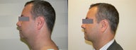Liposuction of the neck to sculpt the neck profile