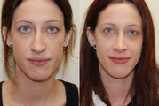 Rhinoplasty Surgery with left spreader graft. 7-months post-op.