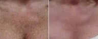 Decolletage Rejuvenation with IPL Photorejuvenation