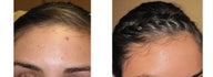 Mole Removal photos