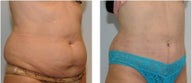 Smart Lipo