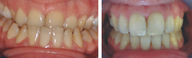 Extreme Invisalign: how to correct an extreme class 3......Underbite
