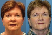 Laser Resurfacing with Exilis tightening