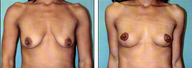Breast lift