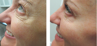Female Ultherapy for Under the Eyes