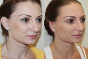 Otoplasty Surgery
