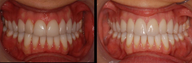 Porcelain Veneers, Subtle Upgrade