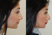 Revision Rhinoplasty. 3 months post-op.