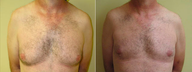 Male Breast Reduction