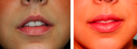 Lip Augmentation 26 Year Old Female
