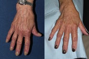 Radiesse Before and After