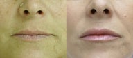 48 year old female treated with Juvederm injections to the lips
