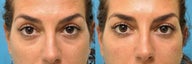 Tear Trough Fillers - Microcannula Technique