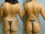 Buttocks enhancement
