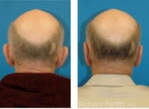 Adult Otoplasty Male