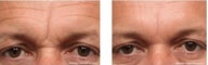 Botox and Fillers to Improve Frown Area