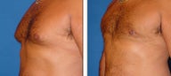 Liposuction Before & After