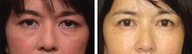 Asian Female Blepharoplasty