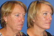 Brow Lift