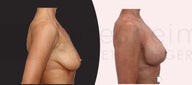 Breast lift with breast implants after weight loss
