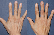 Sclerotherapy For Hand Veins