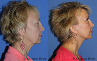 Brow Lift