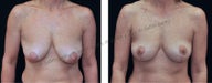 Breast Lift