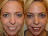 Female treated for glabella, forehead and crows feet
