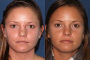 Before and After PDT